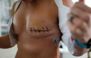 femme ayant eu une mastectomie unilatéral
